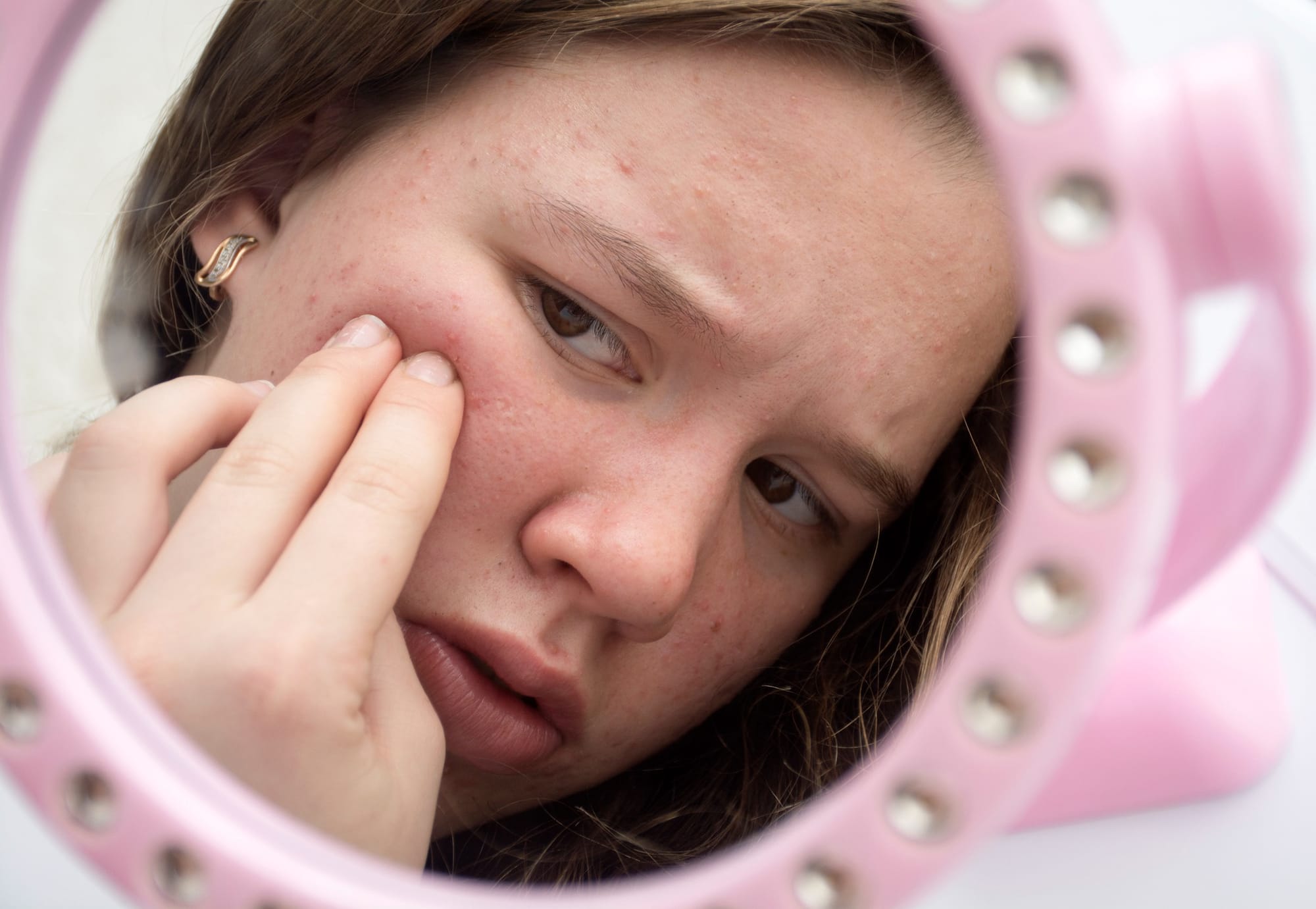 Time to rename PCOS? Global study finds misleading name fuels misdiagnosis