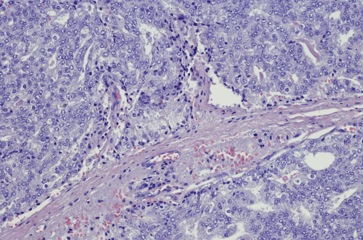 I survived stage four prostate cancer – now I'm meeting the cells